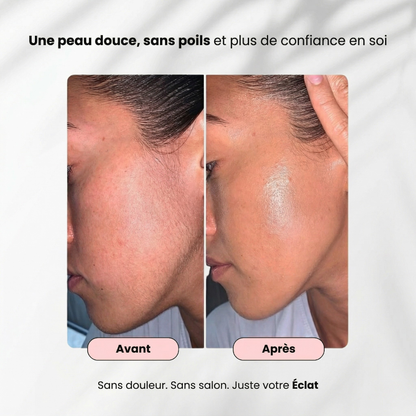 Épilateur Laser Ovéa™