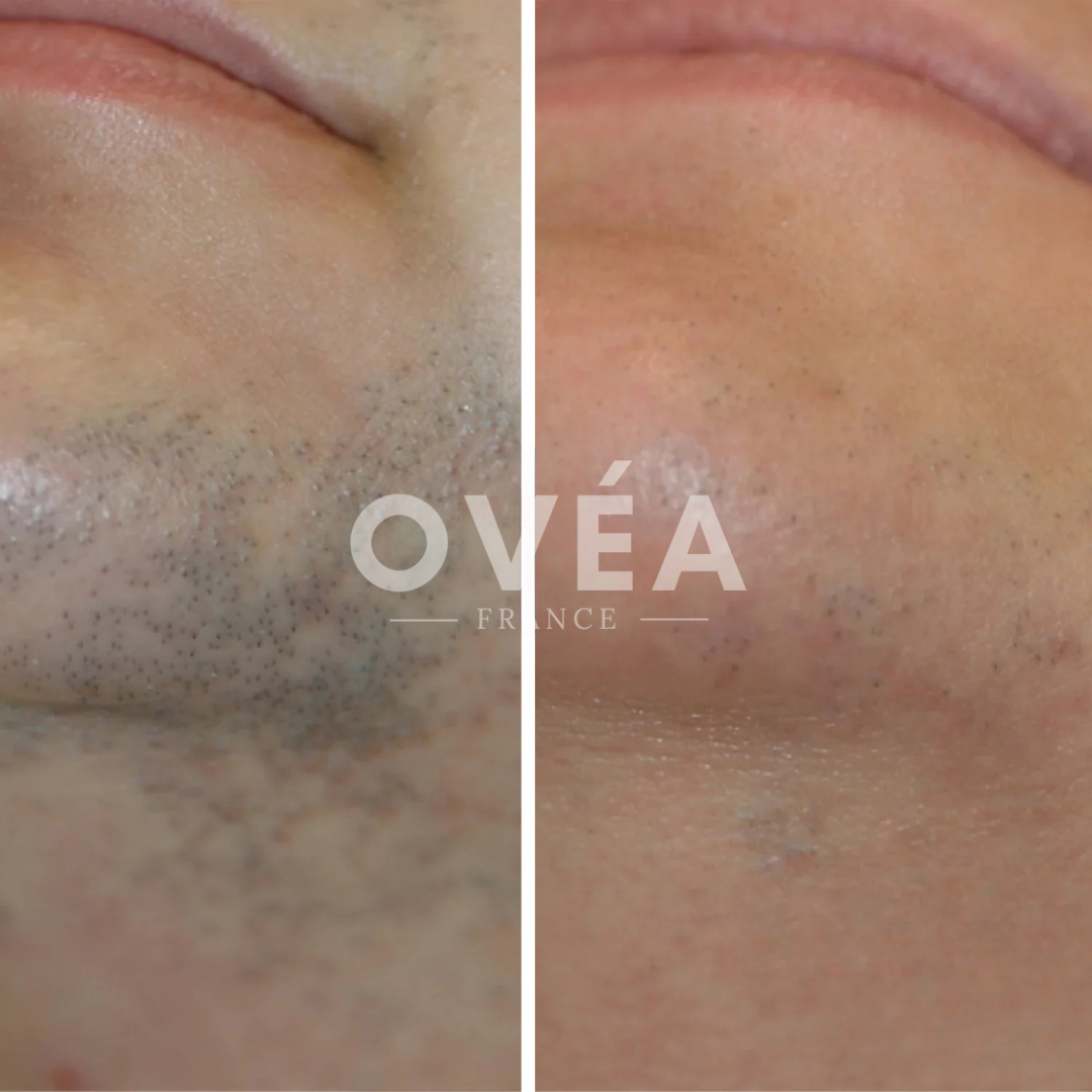 CyperPhase™ – Inhibiteur de Croissance des Poils