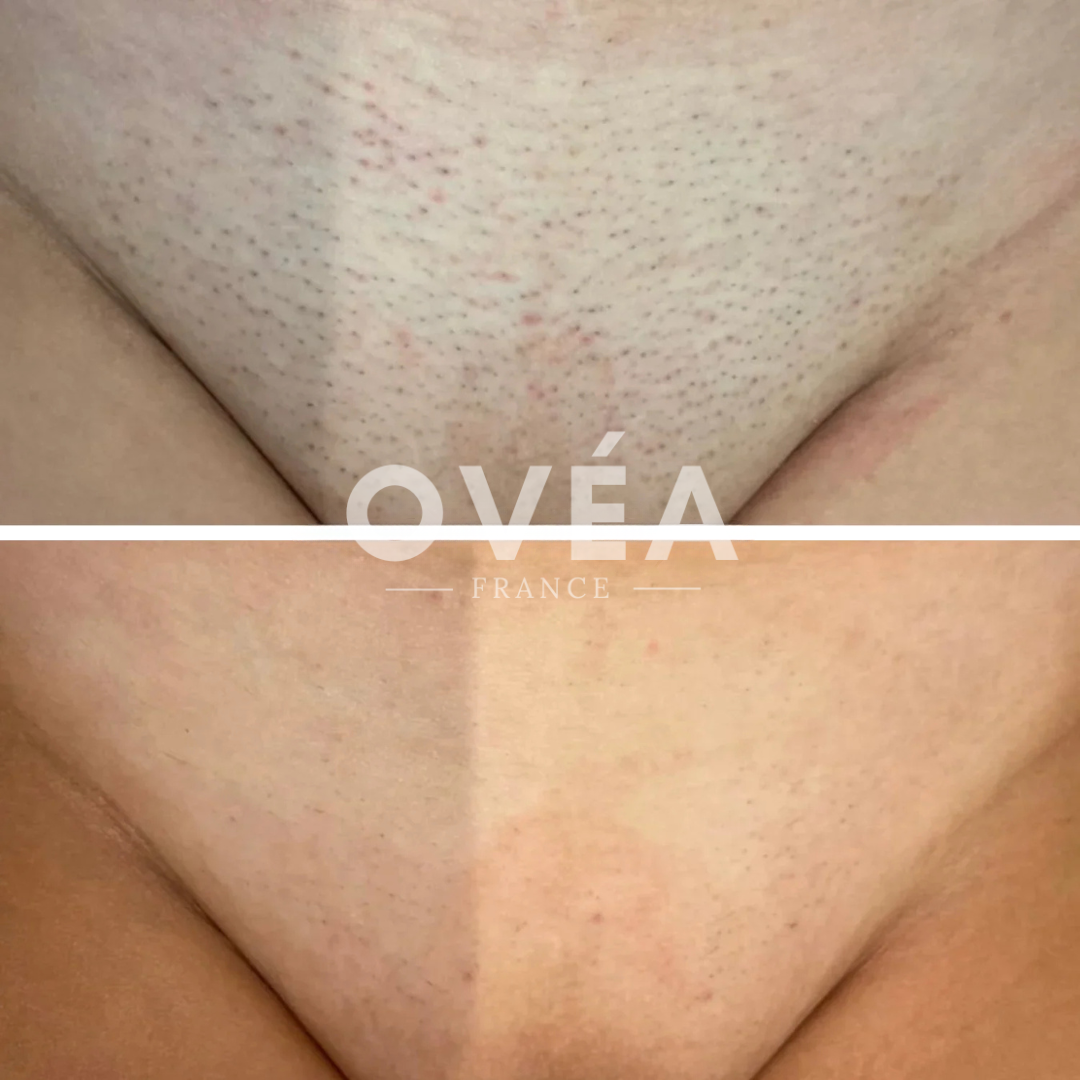 CyperPhase™ – Inhibiteur de Croissance des Poils